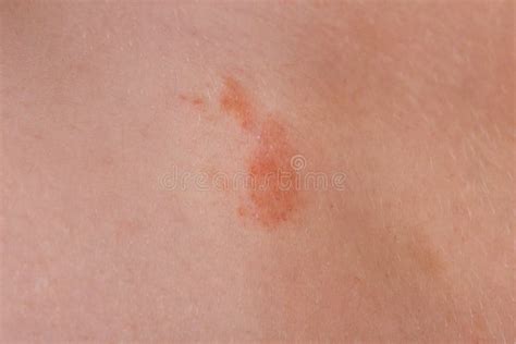 The Great Red Spot On The Skin Closeup Stock Image Image Of Mole