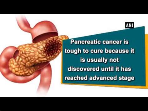 One of those nightmare cancers that tend to progress insidiously and unrecognisably until finally detected at a late and incurable stage. New blood test can detect Pancreatic cancer at early stage ...