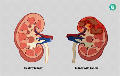 Kidney Cancer Symptoms Causes Treatment Medicine Prevention Diagnosis