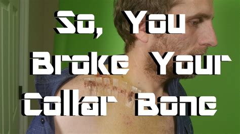 So You Broke Your Collar Bone Advice From Someone Whos Done It Twice