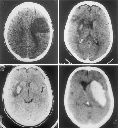 Pdf Hemorrhagic Transformation Within 36 Hours Of A Cerebral Infarct