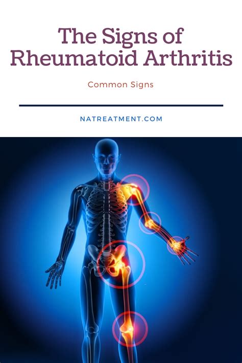 The Signs Of Rheumatoid Arthritis Natural Treatment