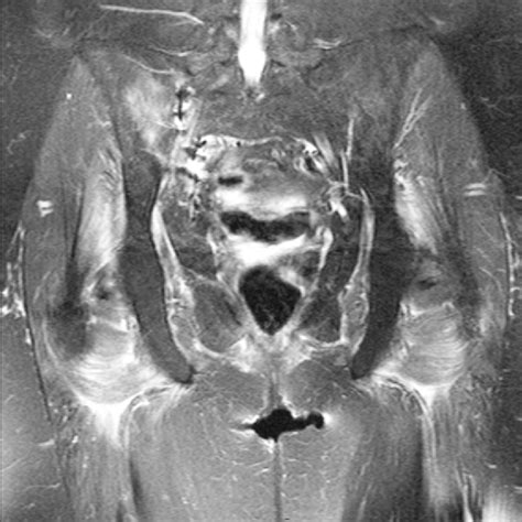 Figure 26 From Soft Tissue Infections And Their Imaging Mimics From