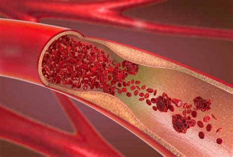 Common Causes And Symptoms Of Blood Clots