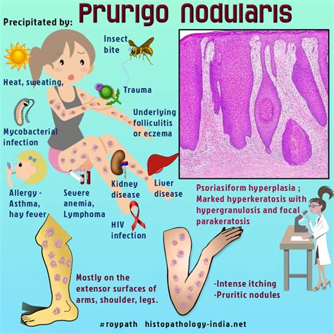 Prurigo Nodularis Intense Itching Skin Disorders Pathology