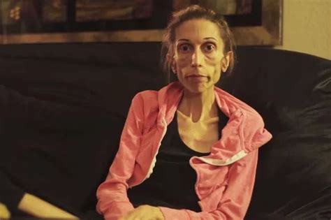 Rachael Farrokh Severely Anorexic Woman Issues Desperate Plea For Help