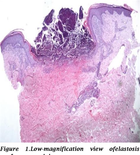 Figure 1 From A Case Of Paraneoplastic Elastosis Perforans Serpiginosa