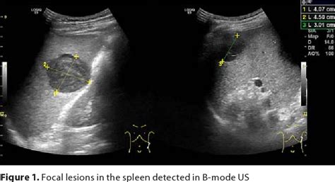 Figure 1 From Primary Spleen Lymphoma Visualized With Contrast Enhanced