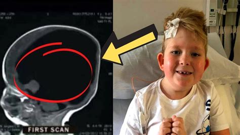 See Baby Boy That Was Born Without Brain 3 Years Later Doctor Scans