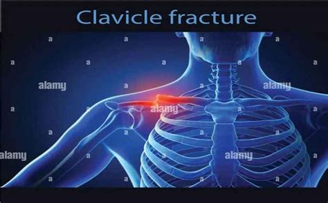 Clavicle Fracture Broken Collarbone Its Causes Symptomsdiagnosis