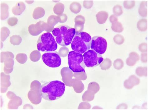 Acute Myeloid Leukemia History