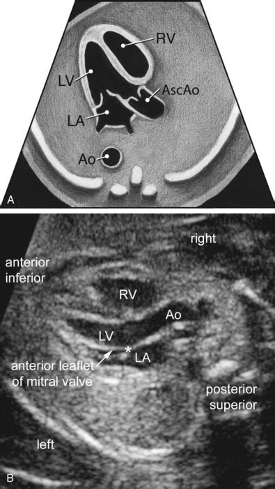 Sonographic Evaluation Of The Fetal Heart Radiology Key
