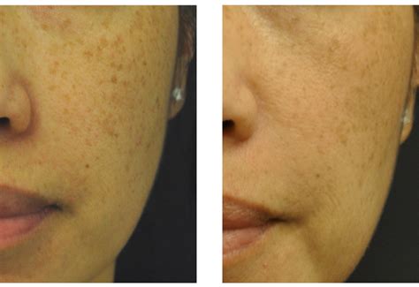 Brown Spots Age Spots And Tattoo Removal San Diego Dermatology And