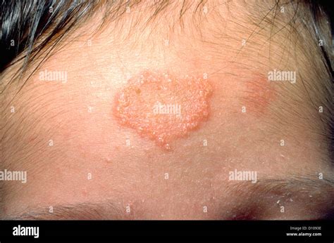 Fungal Rash On The Forehead Stock Photo Alamy