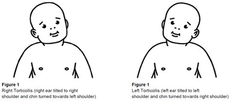 Clinical Practice Guidelines Positional Plagiocephaly