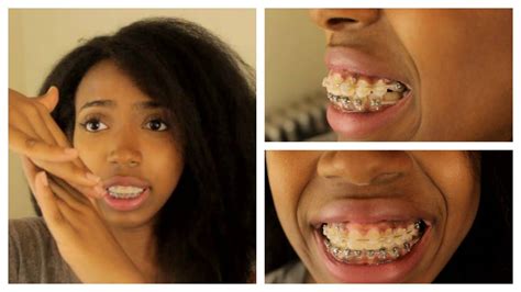 Braces Before And After Crowding Adult