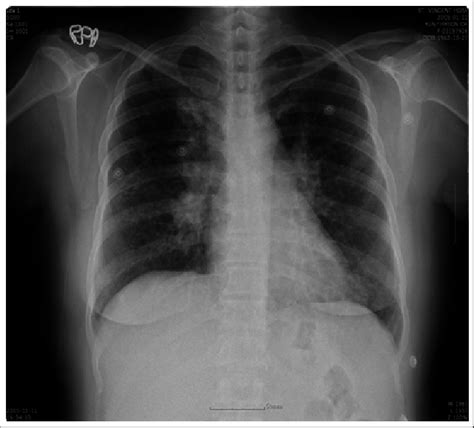 Chest Pa Shows Somewhat Enlarged Bilateral Hilar Shadow And Diffusely