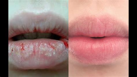 Diy Lip Scrub How To Exfoliate Lips And Get Rid Of Dry Cracked Lips