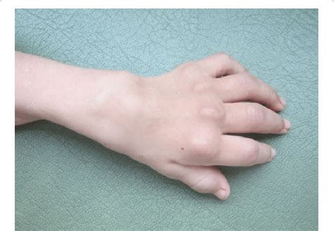 Subcutaneous Skin Nodules Near Interphalangeal Metacarpal And Wrist