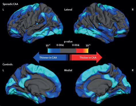 Cortical Atrophy In Patients With Cerebral Amyloid Angiopathy A Case