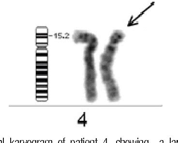Figure From Wolf Hirschhorn Syndrome A Recognized Rare Chromosomal Defect Of Clinical