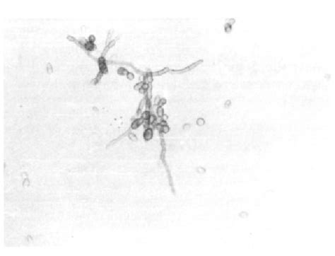 Figure 3 From A Rare Fungal Brain Abscess Caused By Cladosporium