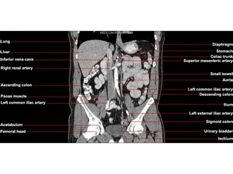 Ct Abdomen And Pelvis Coronal Anatomy In The Male Pelvis Anatomy