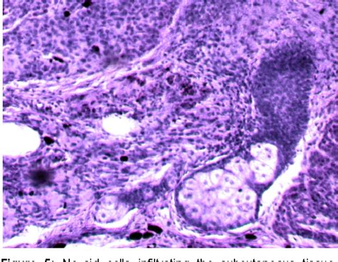Giant Congenital Cerebriform Melanocytic Nevus Of The Scalp In Adult