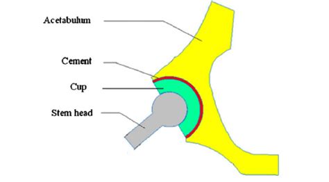 Schematic Representation Of A Reconstructed Acetabulum Download