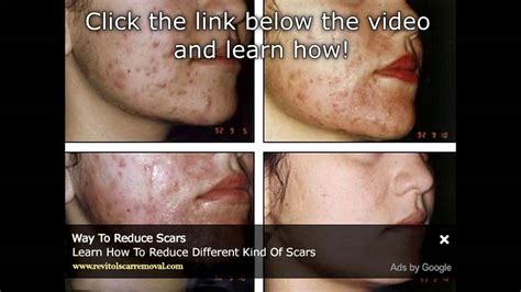 Watch How To Fade Scars And Stretch Marks Naturally Ms Toi How To