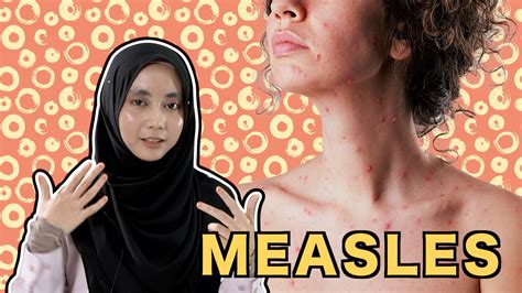Chicken pox juga dikenali sebagai cacar air, jintungan atau bertih (mengikut dialek daerah). Measles - ML Studios