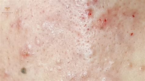 How To Pop Acneblackheadscyst Under Skin At Hien Van Spa434ngọc