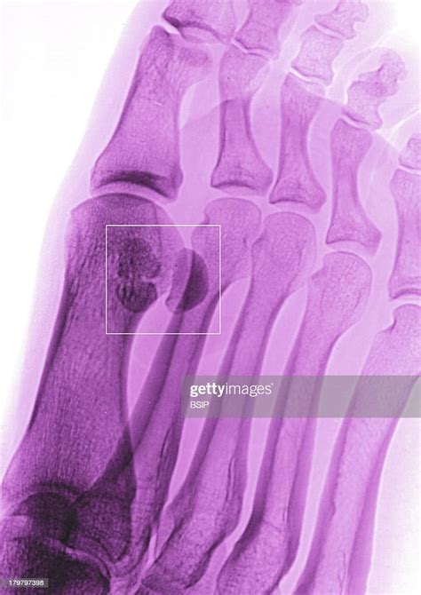 Plantar Wart Foot X Ray Two Warts Between The Big Toe And The Index