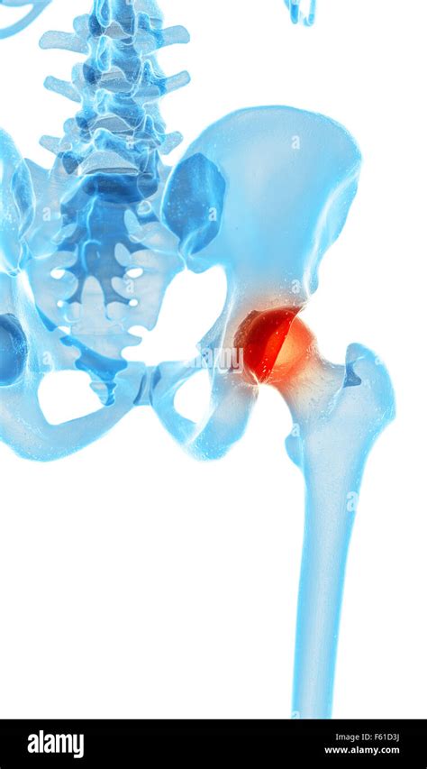 Medically Accurate Illustration Painful Hip Stock Photo Alamy