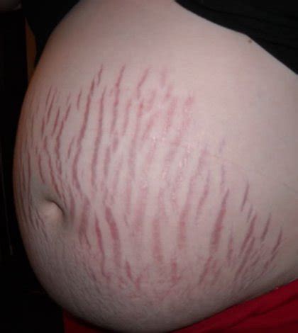 Know More About Pregnancy Caused Scar And Stretch Marks Treatment