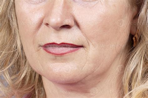 The Lower Part Of The Face And Neck Of An Elderly Woman With Signs Of