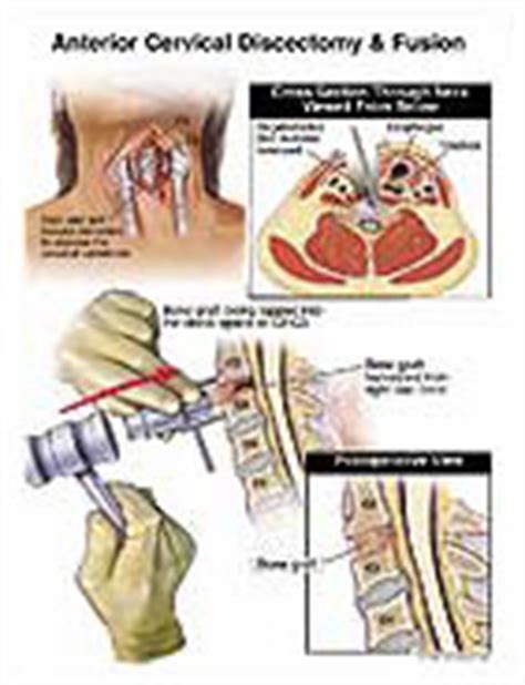Anterior Cervical Discectomy Fusion Medical Illustration Medivisuals