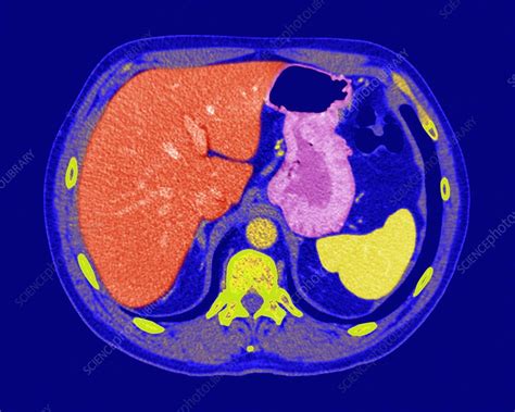 Normal Abdominal Organs Ct Scan Stock Image C0166689 Science
