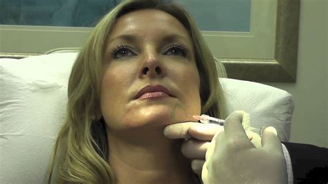 Rejuvenation Of The Lower Face With Injectable Filler Youtube
