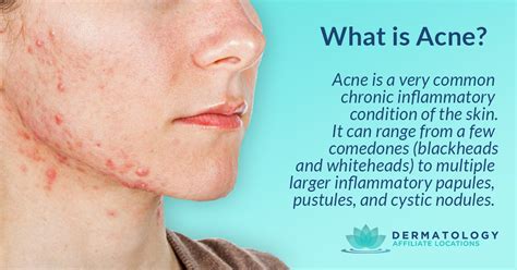Acne Everything To Know About This Pesky Skin Condition Sjh Derm