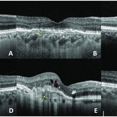 Optical Coherence Tomography Oct Images Show Examples Of Lesions In