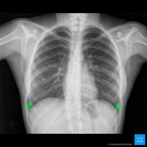 Normal Chest X Ray Pa View Female