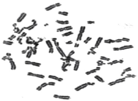 Sickle Cell Anemia Karyotype