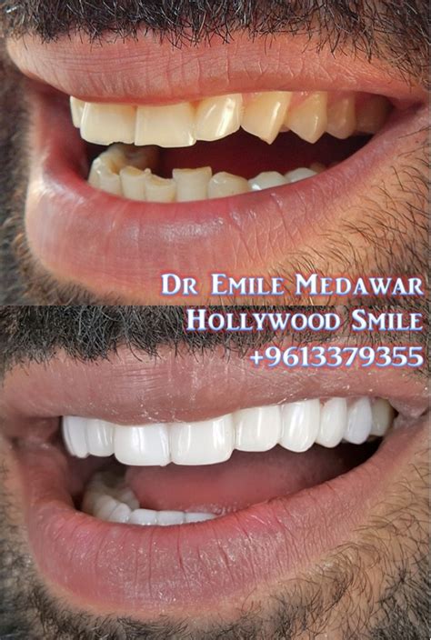 The texts are the property of their respective authors and we thank them for giving us the opportunity to share for free to. Direct Veneers | Emax Veneers Lebanon
