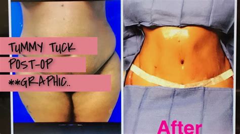 Tummy Tuck Post Op Day 1 Warning Graphic Pics Youtube