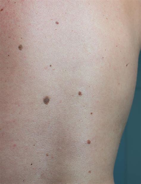 Close Up The Melanoma Black Spot On Human Skin Stock Photo Image Of