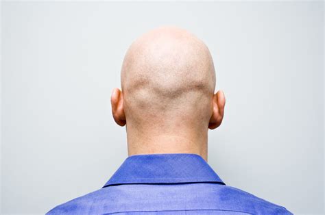 Baldness Cure This Simple Test Can Tell You Whether Or Not You Will Go