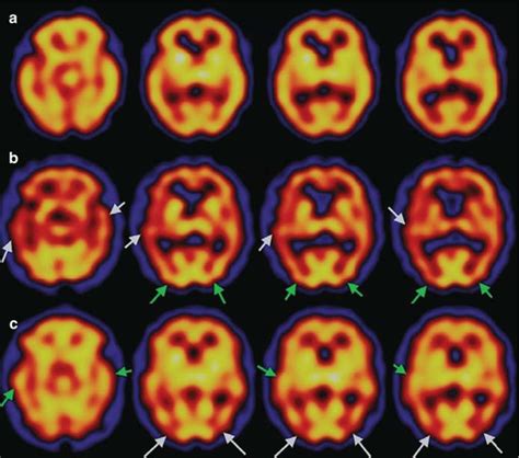 Spectpet Findings In Lewy Body Dementia Radiology Key