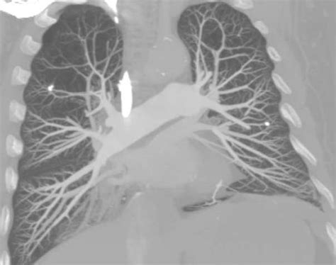 Pulmonary Angiography Beautiful 128 Slice Ct Images Sumers