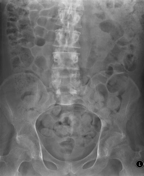 X Ray Of Abdomen Taken On 26 October 2009 Showed Marked Faecal